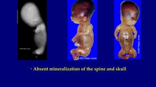 • Absent mineralization of the spine and skull
 