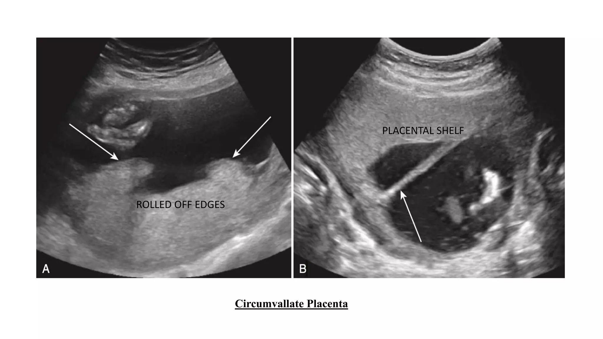 Sonographic Evaluation of Placenta.pptx