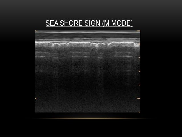 seashore sign _ 肺エコー 肺炎 – MEPQLG