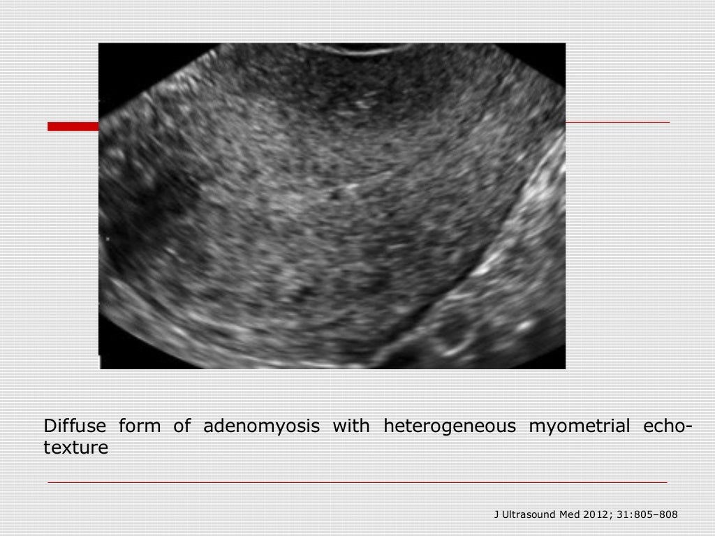 Sonography Of Adenomyosis