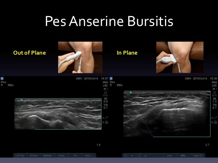anserinus ultrasound anserine extremity injections tendon tendinitis medial hamstring