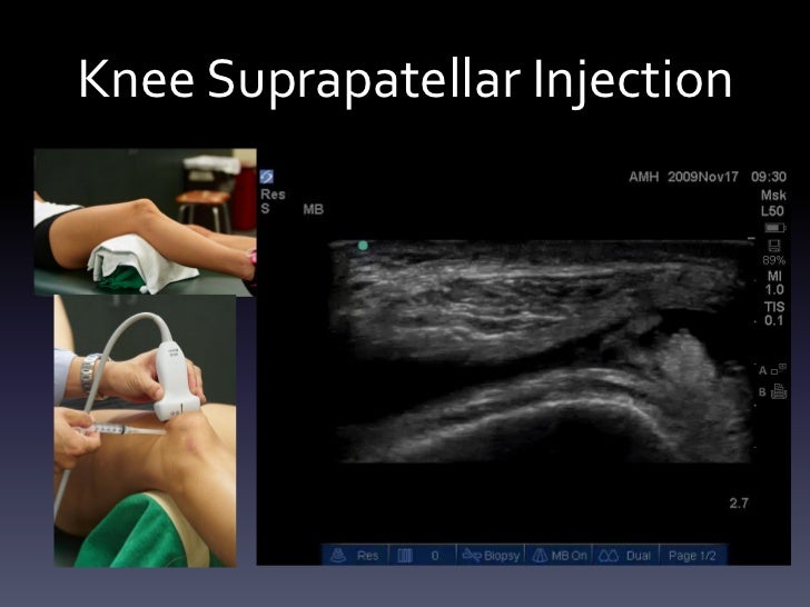 Ultrasound Guided Injections - Lower Extremity