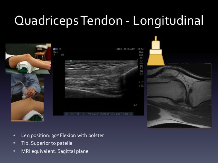 Ultrasound - Knee