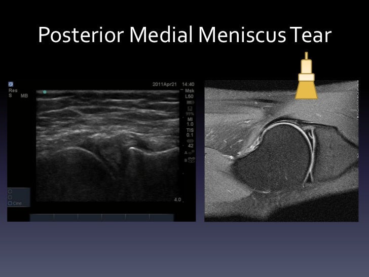 Ultrasound - Knee