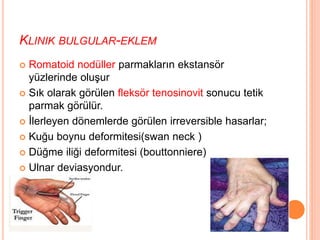 KLINIK BULGULAR-EKLEM
 Romatoid nodüller parmakların ekstansör
yüzlerinde oluşur
 Sık olarak görülen fleksör tenosinovit sonucu tetik
parmak görülür.
 İlerleyen dönemlerde görülen irreversible hasarlar;
 Kuğu boynu deformitesi(swan neck )
 Düğme iliği deformitesi (bouttonniere)
 Ulnar deviasyondur.
 