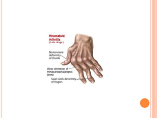 Romatoid Artrit