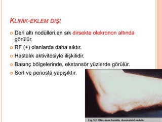 KLINIK-EKLEM DIŞI
 Deri altı nodülleri,en sık dirsekte olekronon altında
görülür.
 RF (+) olanlarda daha sıktır.
 Hastalık aktivitesiyle ilişkilidir.
 Basınç bölgelerinde, ekstansör yüzlerde görülür.
 Sert ve periosta yapışıktır.
 