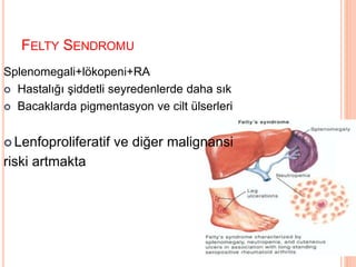 FELTY SENDROMU
Splenomegali+lökopeni+RA
 Hastalığı şiddetli seyredenlerde daha sık
 Bacaklarda pigmentasyon ve cilt ülserleri
 Lenfoproliferatif ve diğer malignansi
riski artmakta
 