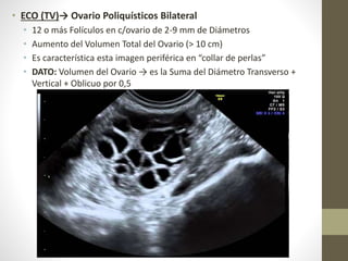 • ECO (TV)→ Ovario Poliquísticos Bilateral
• 12 o más Folículos en c/ovario de 2-9 mm de Diámetros
• Aumento del Volumen Total del Ovario (> 10 cm)
• Es característica esta imagen periférica en “collar de perlas”
• DATO: Volumen del Ovario → es la Suma del Diámetro Transverso +
Vertical + Oblicuo por 0,5
 