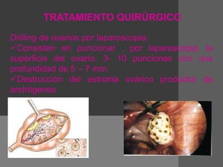 TRATAMIENTO QUIRÚRGICO
Drilling de ovarios por laparoscopia:
Consisten en puncionar , por laparascopia, la
superficie del ovario. 3- 10 punciones con una
profundidad de 5 – 7 mm.
Destrucción del estroma ovárico productor de
andrógenos
 