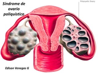 Síndrome de
ovario
poliquístico
Edison Venegas G
 