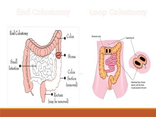 Simple Loop Colostomy SOP FOR OSTOMY CARE power point presentation | PPTX