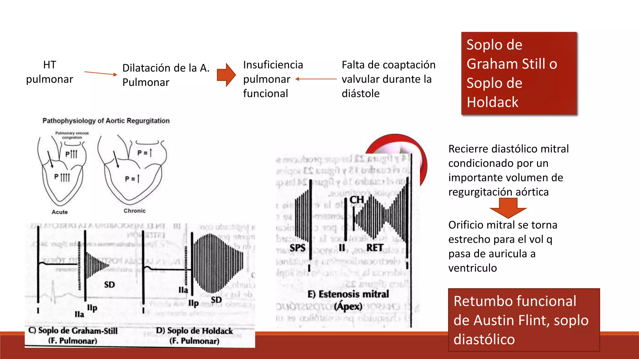 Soplos cardiacos | PPTX