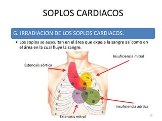 G. IRRADIACION DE LOS SOPLOS CARDIACOS.
• Los soplos se auscultan en el área que expele la sangre así como en
el área en la cual fluye la sangre.
SOPLOS CARDIACOS
20
Insuficiencia mitral
Estenosis mitral
Insuficiencia aórtica
Estenosis aórtica
 