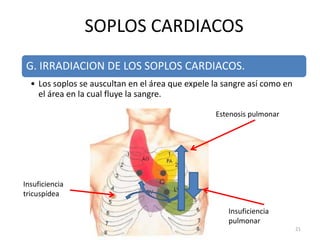 G. IRRADIACION DE LOS SOPLOS CARDIACOS.
• Los soplos se auscultan en el área que expele la sangre así como en
el área en la cual fluye la sangre.
SOPLOS CARDIACOS
21
Insuficiencia
tricuspídea
Insuficiencia
pulmonar
Estenosis pulmonar
 