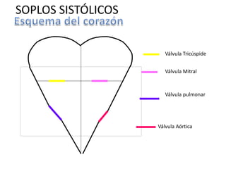 Válvula Aórtica
Válvula pulmonar
Válvula Mitral
Válvula Tricúspide
SOPLOS SISTÓLICOS
 