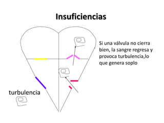 Insuficiencias
Si una válvula no cierra
bien, la sangre regresa y
provoca turbulencia,lo
que genera soplo
turbulencia
 