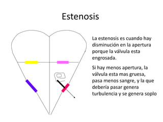 Estenosis
La estenosis es cuando hay
disminución en la apertura
porque la válvula esta
engrosada.
Si hay menos apertura, la
válvula esta mas gruesa,
pasa menos sangre, y la que
debería pasar genera
turbulencia y se genera soplo
 