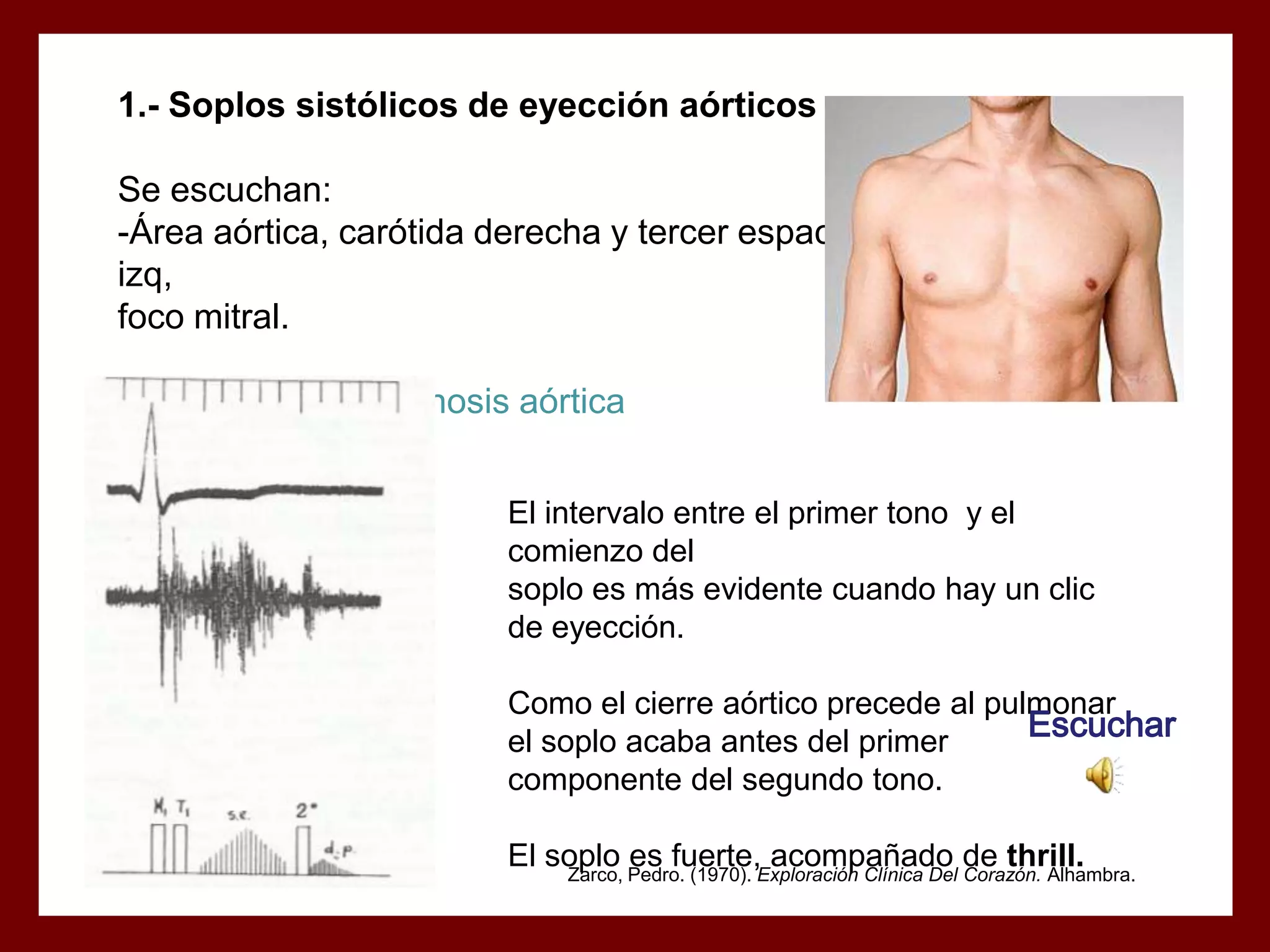 1.- Soplos sistólicos de eyección aórticos
Se escuchan:
-Área aórtica, carótida derecha y tercer espacio intercostar
izq,
foco mitral.
El soplo típico: Estenosis aórtica
El intervalo entre el primer tono y el
comienzo del
soplo es más evidente cuando hay un clic
de eyección.

Como el cierre aórtico precede al pulmonar
Escuchar
el soplo acaba antes del primer
componente del segundo tono.
El soplo Pedro. (1970). Exploración Clínica Del de thrill.
es fuerte, acompañado Corazón. Alhambra.
Zarco,

 