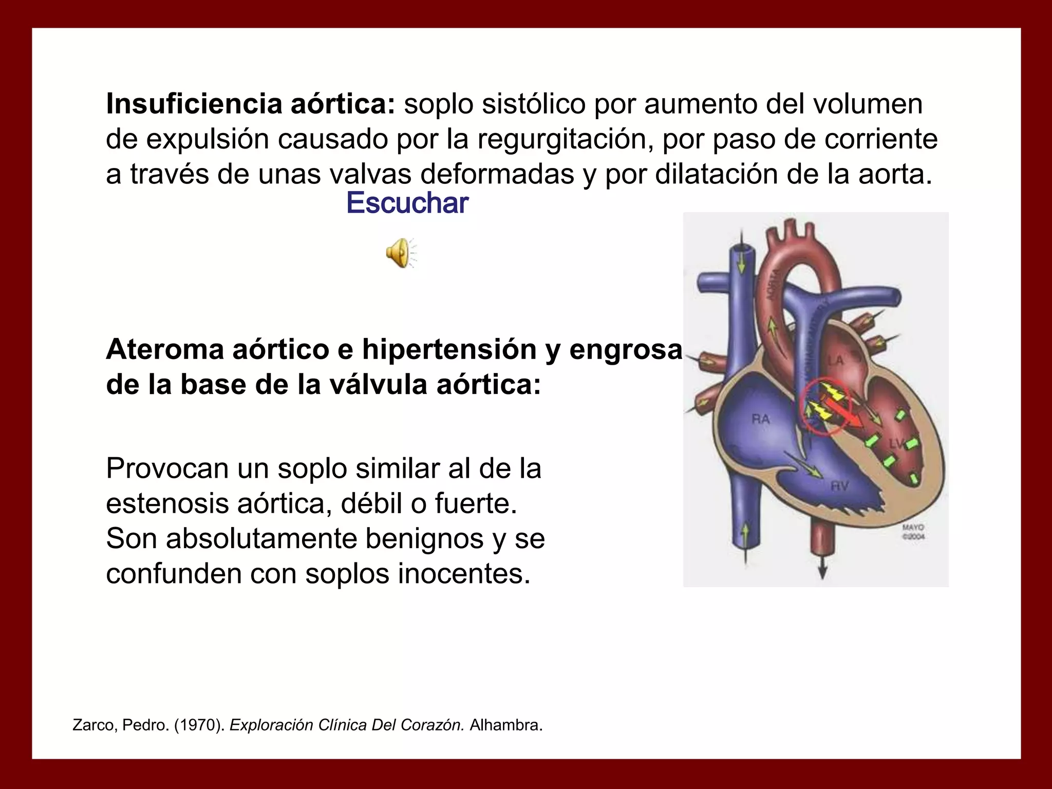Insuficiencia aórtica: soplo sistólico por aumento del volumen
de expulsión causado por la regurgitación, por paso de corriente
a través de unas valvas deformadas y por dilatación de la aorta.
Escuchar

Ateroma aórtico e hipertensión y engrosamiento
de la base de la válvula aórtica:
Provocan un soplo similar al de la
estenosis aórtica, débil o fuerte.
Son absolutamente benignos y se
confunden con soplos inocentes.

Zarco, Pedro. (1970). Exploración Clínica Del Corazón. Alhambra.

 