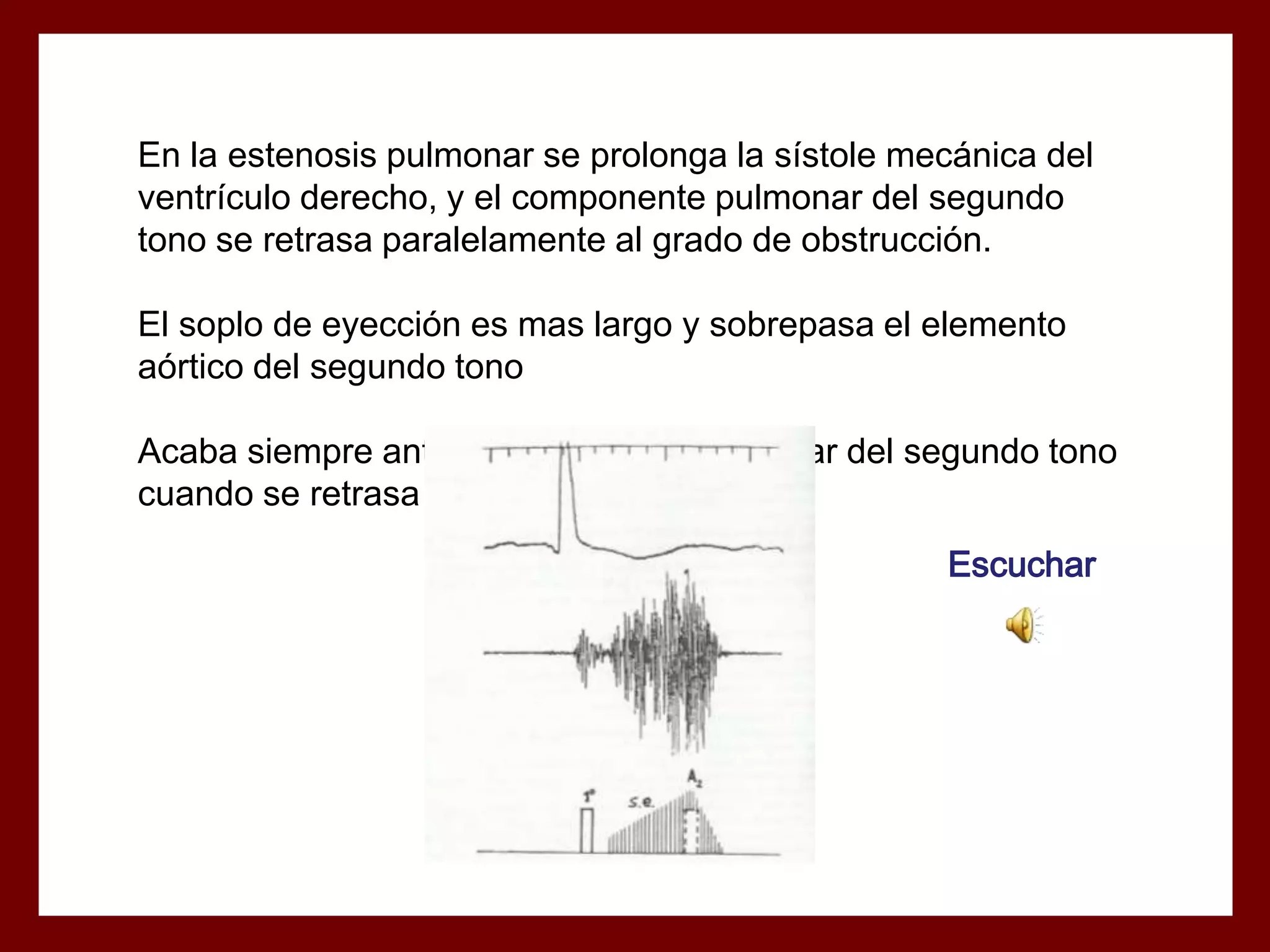 En la estenosis pulmonar se prolonga la sístole mecánica del
ventrículo derecho, y el componente pulmonar del segundo
tono se retrasa paralelamente al grado de obstrucción.
El soplo de eyección es mas largo y sobrepasa el elemento
aórtico del segundo tono

Acaba siempre antes del elemento pulmonar del segundo tono
cuando se retrasa el cierre pulmonar
Escuchar

 