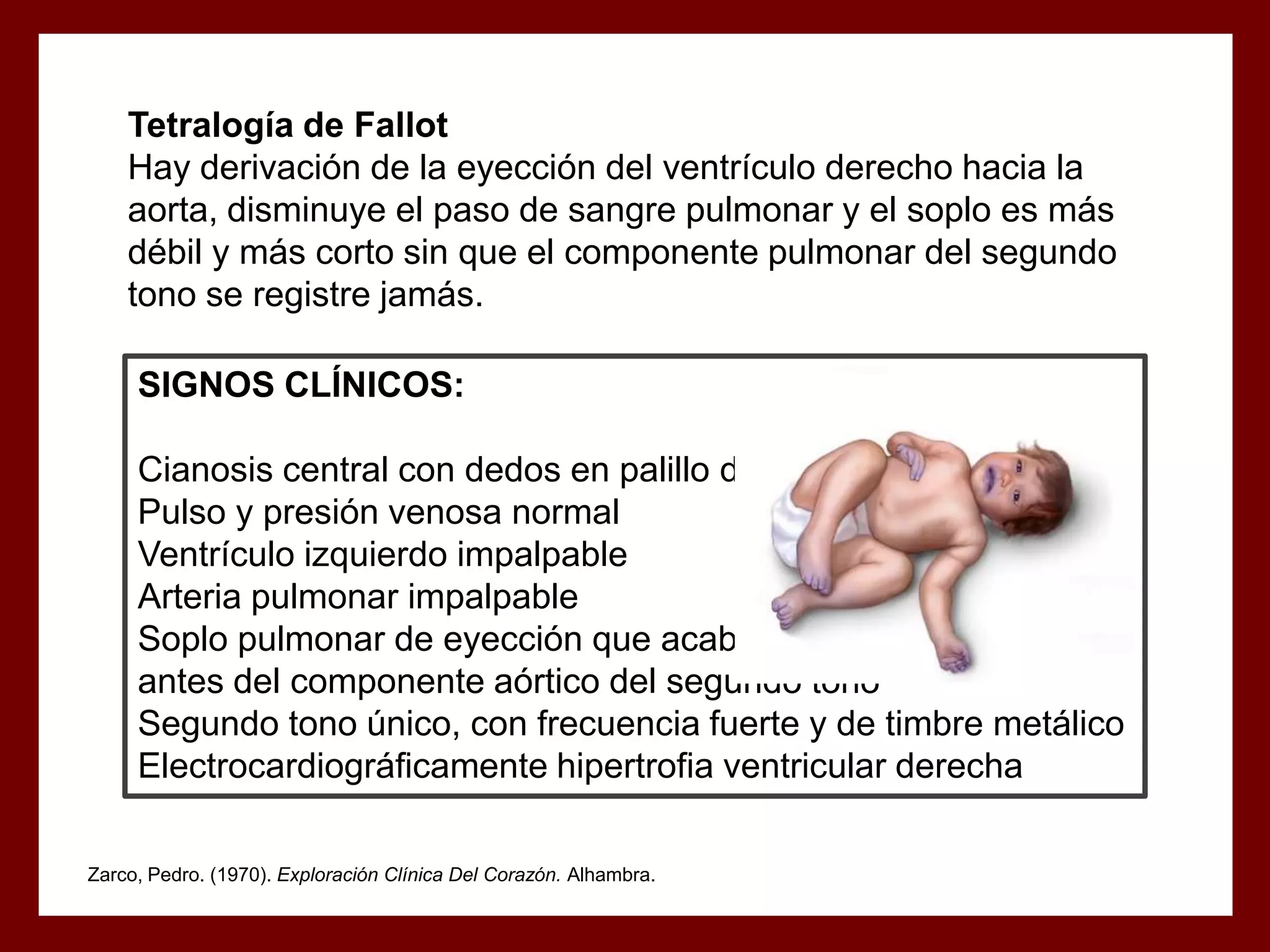 Tetralogía de Fallot
Hay derivación de la eyección del ventrículo derecho hacia la
aorta, disminuye el paso de sangre pulmonar y el soplo es más
débil y más corto sin que el componente pulmonar del segundo
tono se registre jamás.
SIGNOS CLÍNICOS:
Cianosis central con dedos en palillo de tambor
Pulso y presión venosa normal
Ventrículo izquierdo impalpable
Arteria pulmonar impalpable
Soplo pulmonar de eyección que acaba siempre
antes del componente aórtico del segundo tono
Segundo tono único, con frecuencia fuerte y de timbre metálico
Electrocardiográficamente hipertrofia ventricular derecha
Zarco, Pedro. (1970). Exploración Clínica Del Corazón. Alhambra.

 
