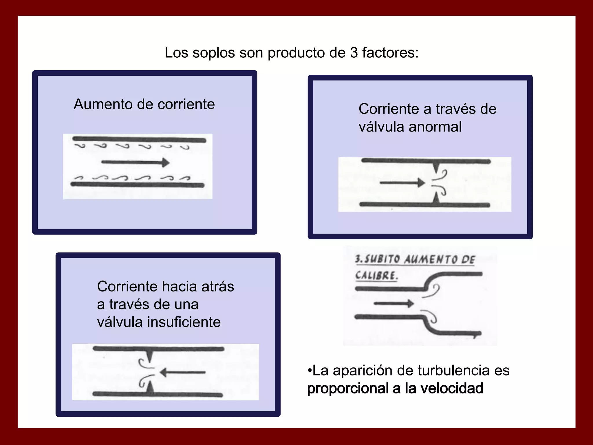 Los soplos son producto de 3 factores:

Aumento de corriente

Corriente a través de
válvula anormal

Corriente hacia atrás
a través de una
válvula insuficiente
•La aparición de turbulencia es
proporcional a la velocidad

 
