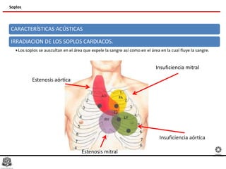 Soplos
CARACTERÍSTICAS ACÚSTICAS
IRRADIACION DE LOS SOPLOS CARDIACOS.
•Los soplos se auscultan en el área que expele la sangre así como en el área en la cual fluye la sangre.
Insuficiencia mitral
Estenosis mitral
Insuficiencia aórtica
Estenosis aórtica
 