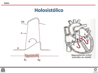 Holosistólico
Soplos
 