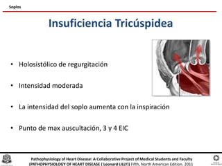 Insuficiencia Tricúspidea
• Holosistólico de regurgitación
• Intensidad moderada
• La intensidad del soplo aumenta con la inspiración
• Punto de max auscultación, 3 y 4 EIC
Soplos
Pathophysiology of Heart Disease: A Collaborative Project of Medical Students and Faculty
(PATHOPHYSIOLOGY OF HEART DISEASE ( Leonard LILLY)) Fifth, North American Edition. 2011
 