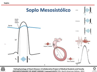 Soplo Mesosistólico
Soplos
Pathophysiology of Heart Disease: A Collaborative Project of Medical Students and Faculty
(PATHOPHYSIOLOGY OF HEART DISEASE ( Leonard LILLY)) Fifth, North American Edition. 2011
 