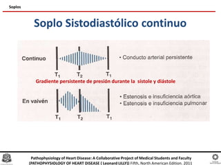 Soplo Sistodiastólico continuo
Soplos
Gradiente persistente de presión durante la sístole y diástole
Pathophysiology of Heart Disease: A Collaborative Project of Medical Students and Faculty
(PATHOPHYSIOLOGY OF HEART DISEASE ( Leonard LILLY)) Fifth, North American Edition. 2011
 