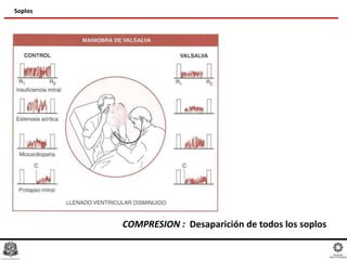 Soplos
COMPRESION : Desaparición de todos los soplos
 
