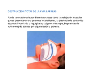 OBSTRUCCION TOTAL DE LAS VIAS AEREAS

Puede ser ocasionado por diferentes causas como las relajación muscular
que se presenta en una personas inconscientes, la presencia de contenido
estomacal vomitado o regurgitado, coágulos de sangre, fragmentos de
hueso o tejido dañado por alguna lesión o prótesis.
 