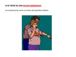 SI SE TRATA DE UNA MUJER EMBARZADA:

Las compresiones serán a la altura del apéndice xifoides
 