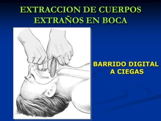 EXTRACCION DE CUERPOS
  EXTRAÑOS EN BOCA



            BARRIDO DIGITAL
                A CIEGAS
 