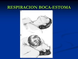 RESPIRACION BOCA-ESTOMA
 