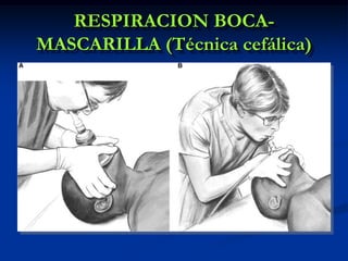 RESPIRACION BOCA-
MASCARILLA (Técnica cefálica)
 