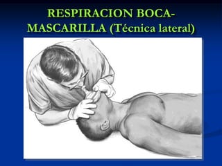 RESPIRACION BOCA-
MASCARILLA (Técnica lateral)
 