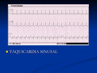 TAQUICARDIA SINUSAL 