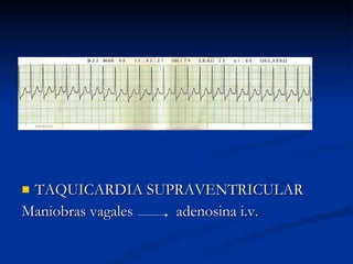 TAQUICARDIA SUPRAVENTRICULAR Maniobras vagales  adenosina i.v. 