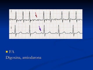 FA Digoxina, amiodarona 