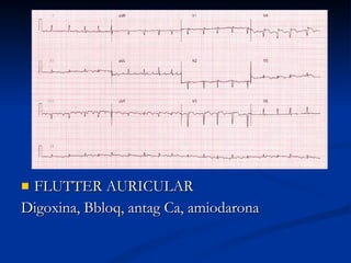 FLUTTER AURICULAR Digoxina, Bbloq, antag Ca, amiodarona 