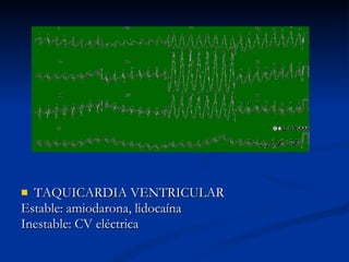 TAQUICARDIA VENTRICULAR Estable: amiodarona, lidocaína Inestable: CV eléctrica 
