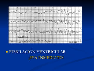 FIBRILACIÓN VENTRICULAR ¡SVA INMEDIATO! 