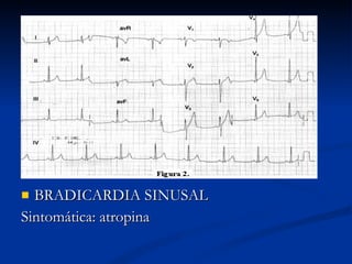 BRADICARDIA SINUSAL Sintomática: atropina 