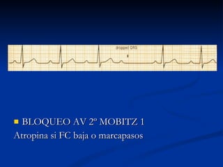 BLOQUEO AV 2º MOBITZ 1 Atropina si FC baja o marcapasos 