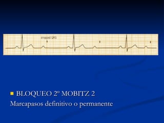 BLOQUEO 2º MOBITZ 2 Marcapasos definitivo o permanente 