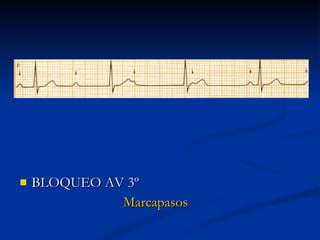 BLOQUEO AV 3º Marcapasos 