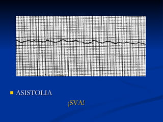 ASISTOLIA ¡SVA! 